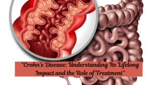 “Crohn’s Disease: Understanding Its Lifelong Impact and the Role of Treatment”